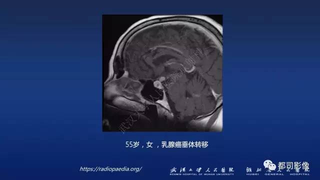 【PPT】侵袭性垂体瘤MRI与临床