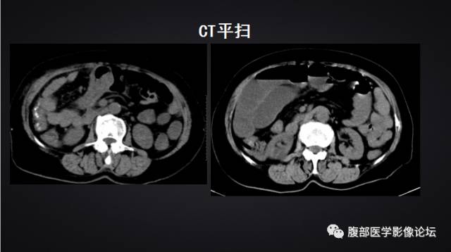 【病例】回盲部淋巴瘤一例CT 【病例】回盲部淋巴瘤一例CT