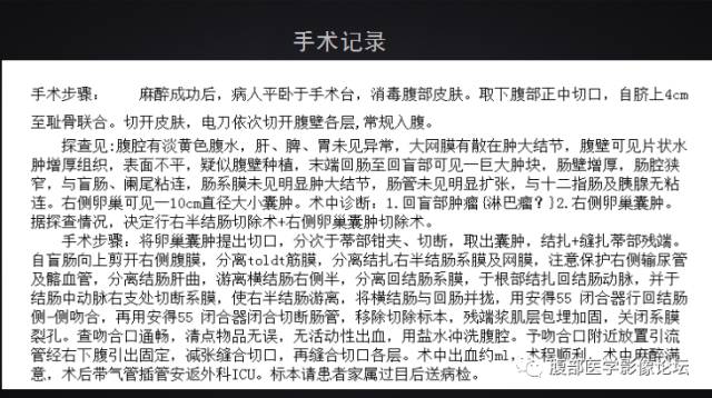 【病例】回盲部淋巴瘤一例CT 【病例】回盲部淋巴瘤一例CT