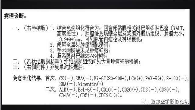 【病例】回盲部淋巴瘤一例CT 【病例】回盲部淋巴瘤一例CT