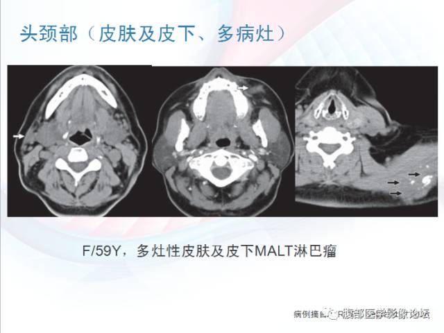 【PPT】粘膜相关淋巴组织淋巴瘤