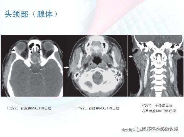【PPT】粘膜相关淋巴组织淋巴瘤