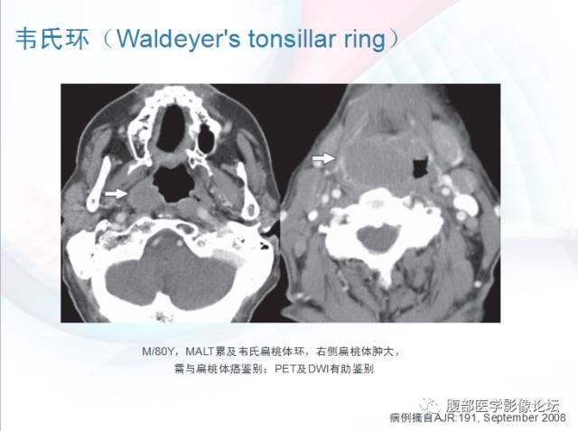 【PPT】粘膜相关淋巴组织淋巴瘤