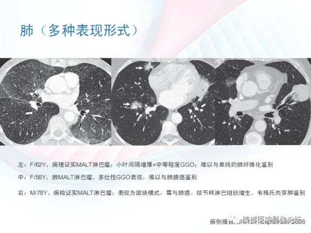 【PPT】粘膜相关淋巴组织淋巴瘤