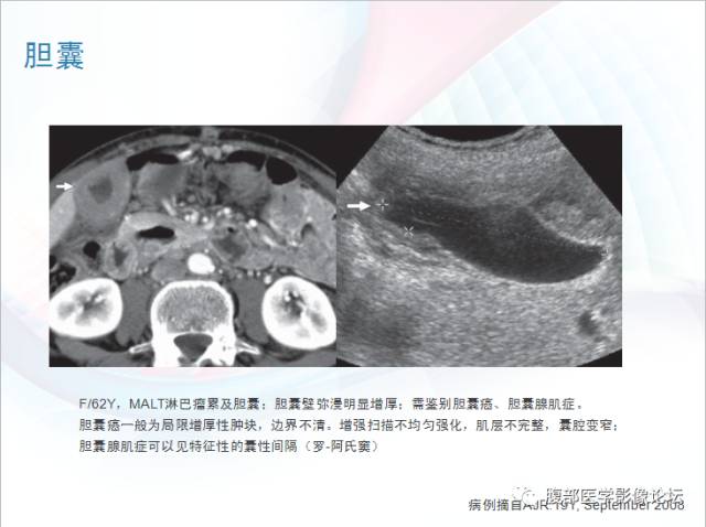 【PPT】粘膜相关淋巴组织淋巴瘤