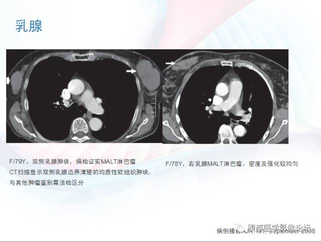 【PPT】粘膜相关淋巴组织淋巴瘤