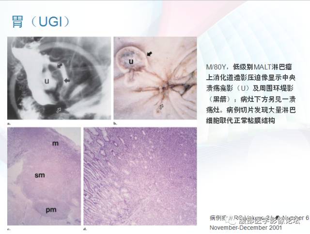 【PPT】粘膜相关淋巴组织淋巴瘤