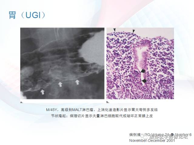 【PPT】粘膜相关淋巴组织淋巴瘤