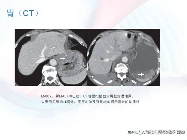【PPT】粘膜相关淋巴组织淋巴瘤