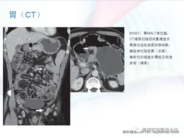 【PPT】粘膜相关淋巴组织淋巴瘤