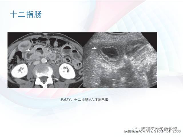 【PPT】粘膜相关淋巴组织淋巴瘤