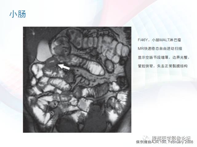【PPT】粘膜相关淋巴组织淋巴瘤