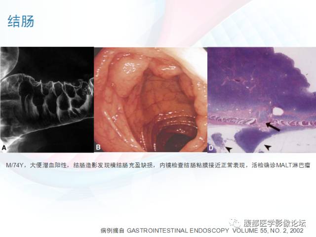 【PPT】粘膜相关淋巴组织淋巴瘤
