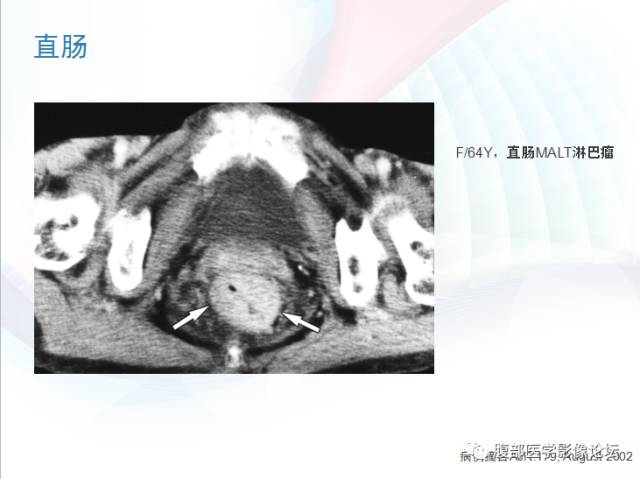 【PPT】粘膜相关淋巴组织淋巴瘤