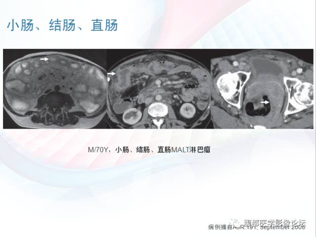 【PPT】粘膜相关淋巴组织淋巴瘤