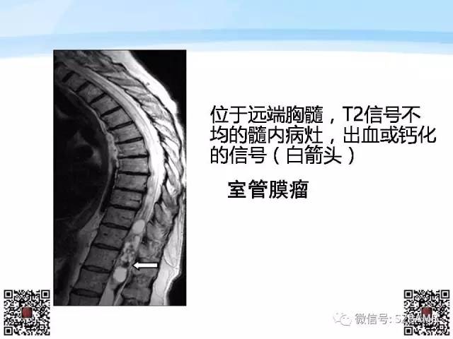 【PPT】脊髓肿瘤MR表现