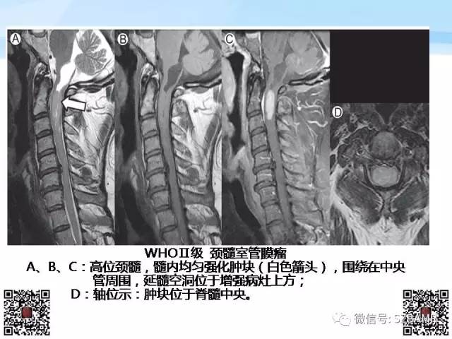 【PPT】脊髓肿瘤MR表现