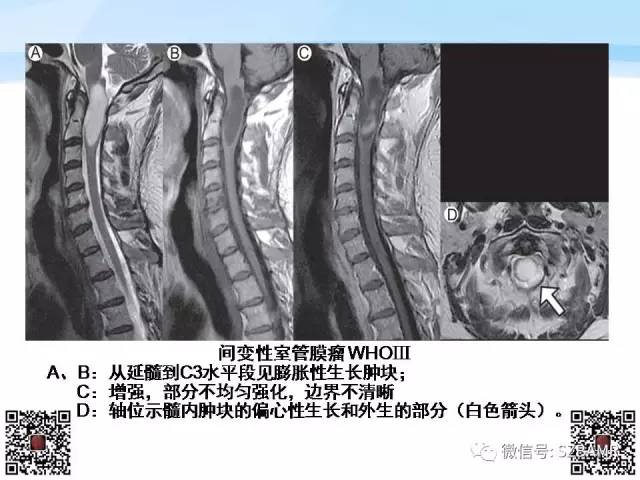 【PPT】脊髓肿瘤MR表现