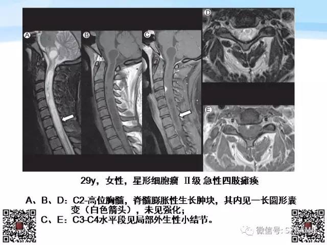 【PPT】脊髓肿瘤MR表现