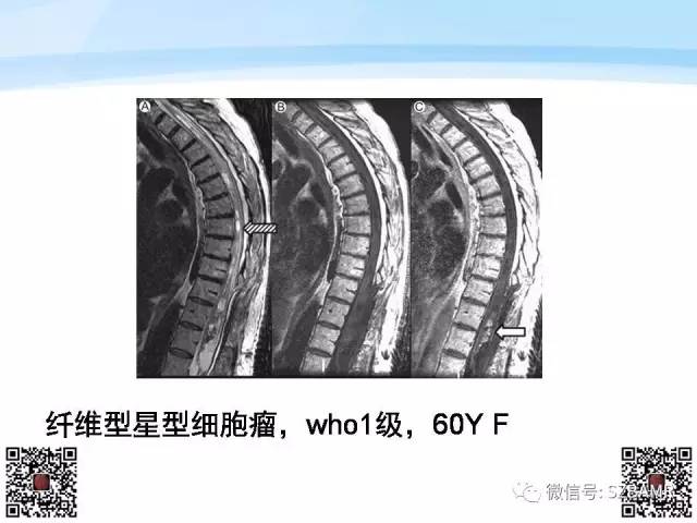 【PPT】脊髓肿瘤MR表现