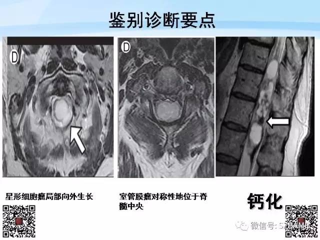 【PPT】脊髓肿瘤MR表现