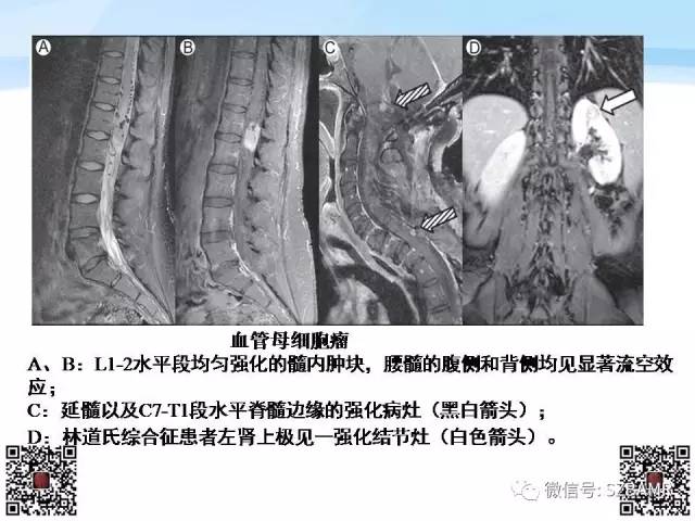 【PPT】脊髓肿瘤MR表现