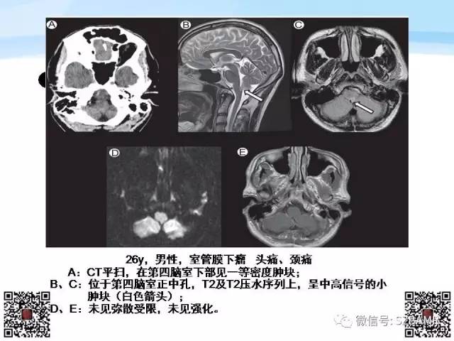 【PPT】脊髓肿瘤MR表现
