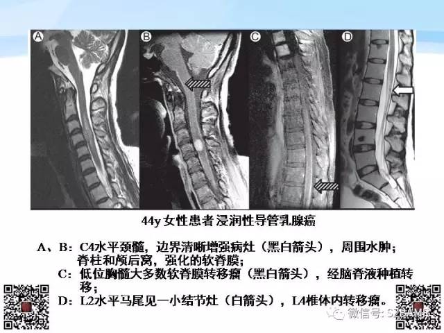 【PPT】脊髓肿瘤MR表现