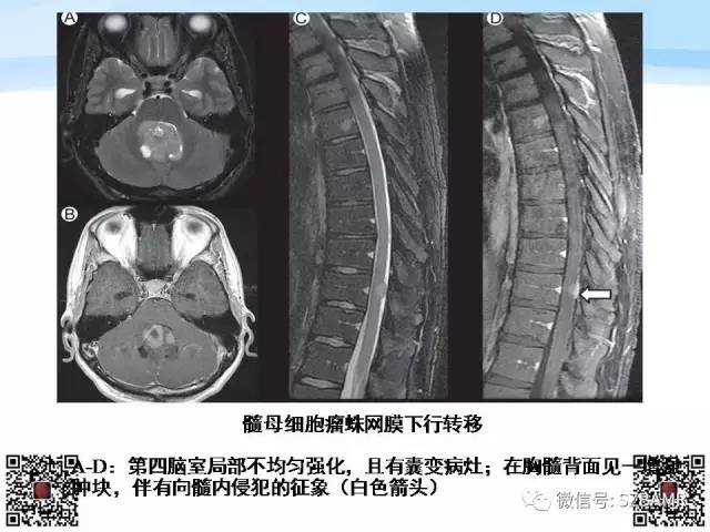 【PPT】脊髓肿瘤MR表现
