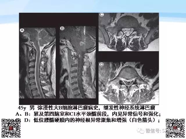 【PPT】脊髓肿瘤MR表现