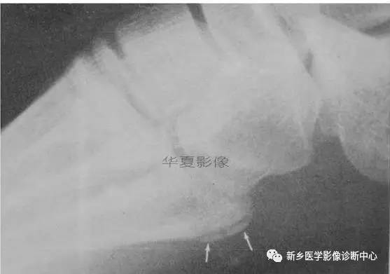 下肢骨,你应该想到的48种变异 下肢骨,你应该想到的48种变异