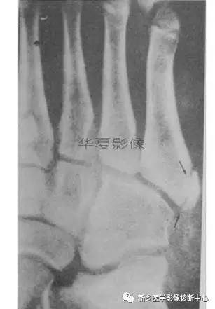 下肢骨,你应该想到的48种变异 下肢骨,你应该想到的48种变异