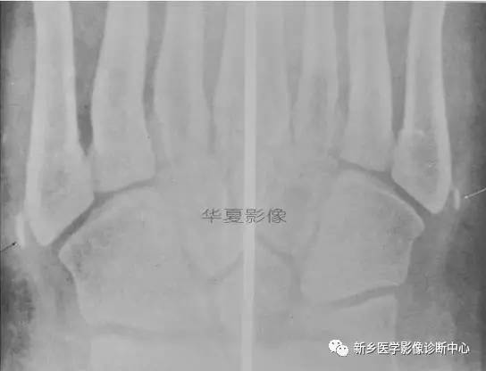 下肢骨,你应该想到的48种变异 下肢骨,你应该想到的48种变异