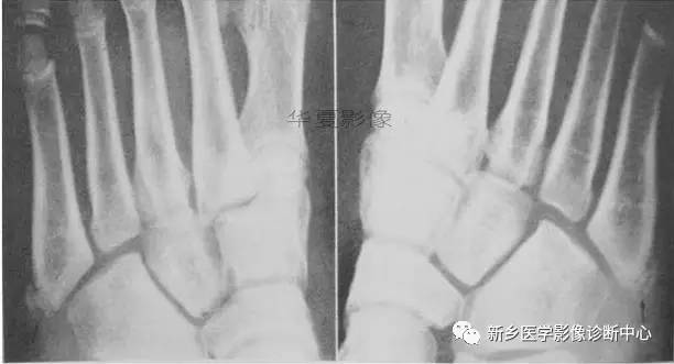 下肢骨,你应该想到的48种变异 下肢骨,你应该想到的48种变异