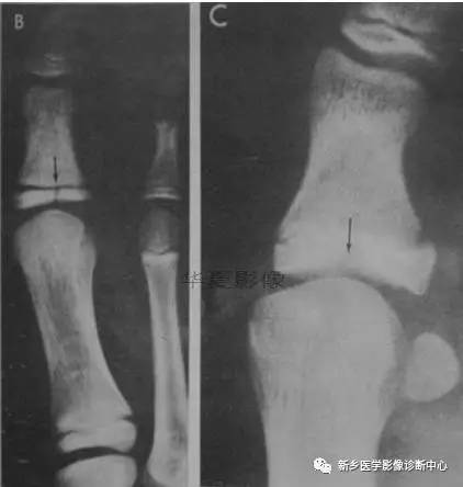 下肢骨,你应该想到的48种变异 下肢骨,你应该想到的48种变异