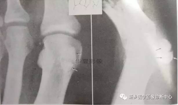下肢骨,你应该想到的48种变异 下肢骨,你应该想到的48种变异
