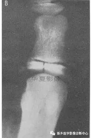 下肢骨,你应该想到的48种变异 下肢骨,你应该想到的48种变异