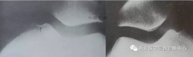 下肢骨,你应该想到的48种变异 下肢骨,你应该想到的48种变异