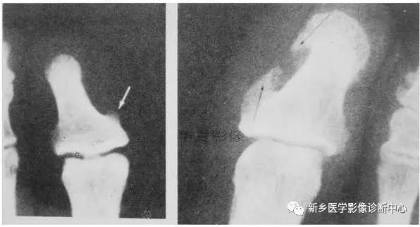 下肢骨,你应该想到的48种变异 下肢骨,你应该想到的48种变异