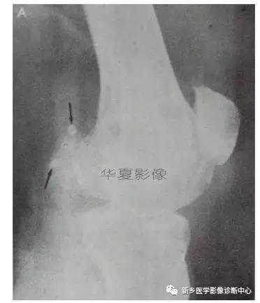 下肢骨,你应该想到的48种变异 下肢骨,你应该想到的48种变异