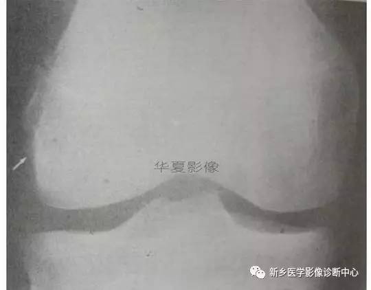 下肢骨,你应该想到的48种变异 下肢骨,你应该想到的48种变异