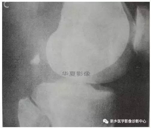 下肢骨,你应该想到的48种变异 下肢骨,你应该想到的48种变异