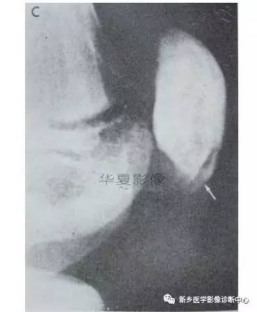 下肢骨,你应该想到的48种变异 下肢骨,你应该想到的48种变异