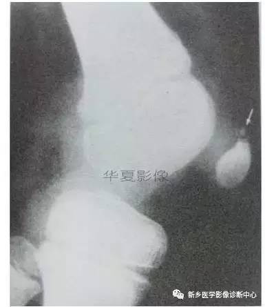 下肢骨,你应该想到的48种变异 下肢骨,你应该想到的48种变异