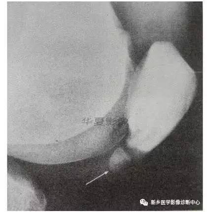 下肢骨,你应该想到的48种变异 下肢骨,你应该想到的48种变异