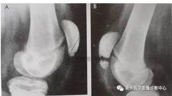 下肢骨,你应该想到的48种变异 下肢骨,你应该想到的48种变异