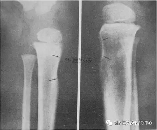下肢骨,你应该想到的48种变异 下肢骨,你应该想到的48种变异