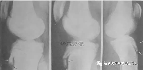 下肢骨，你应该想到的48种变异