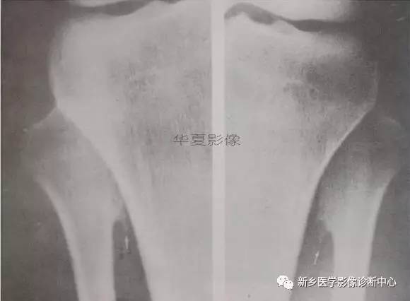 下肢骨,你应该想到的48种变异 下肢骨,你应该想到的48种变异