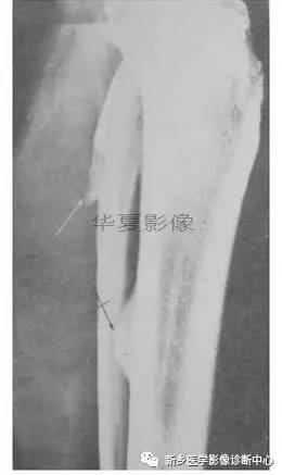 下肢骨,你应该想到的48种变异 下肢骨,你应该想到的48种变异